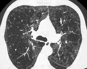 Image: Computed Tomography (CT) scan in axial section of the lungs in an adult patient, showing chronic obstructive pulmonary disease (COPD) with centrilobular emphysema (Photo courtesy of Michel Brauner / ISM).